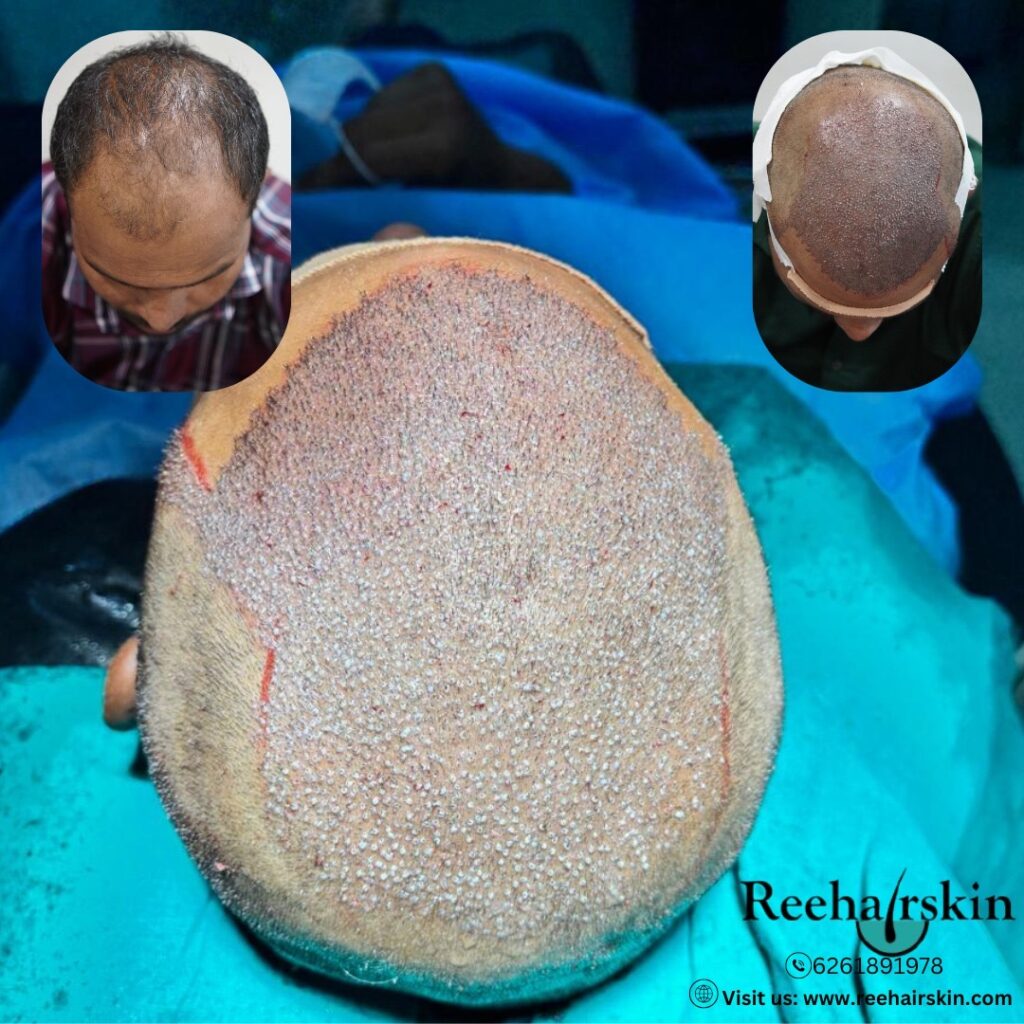 Looking for hair transplant in India , then scroll Reehairskin website and observe the real result by real doctors . Male and female hair transplant at Reehairskin India